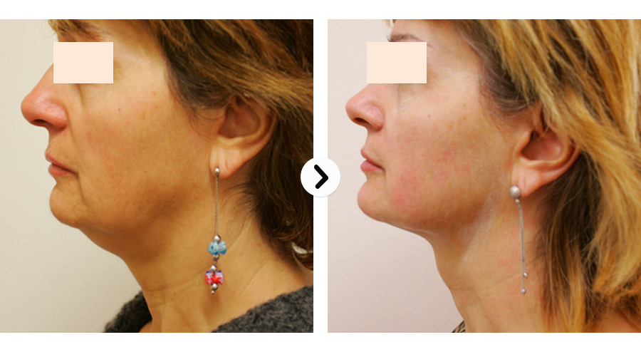 50+ Hifu vorher nachher bilder , HIFU Ultraschall Face Lift To Be Beautiful