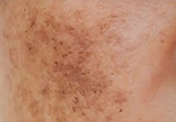 Melasma